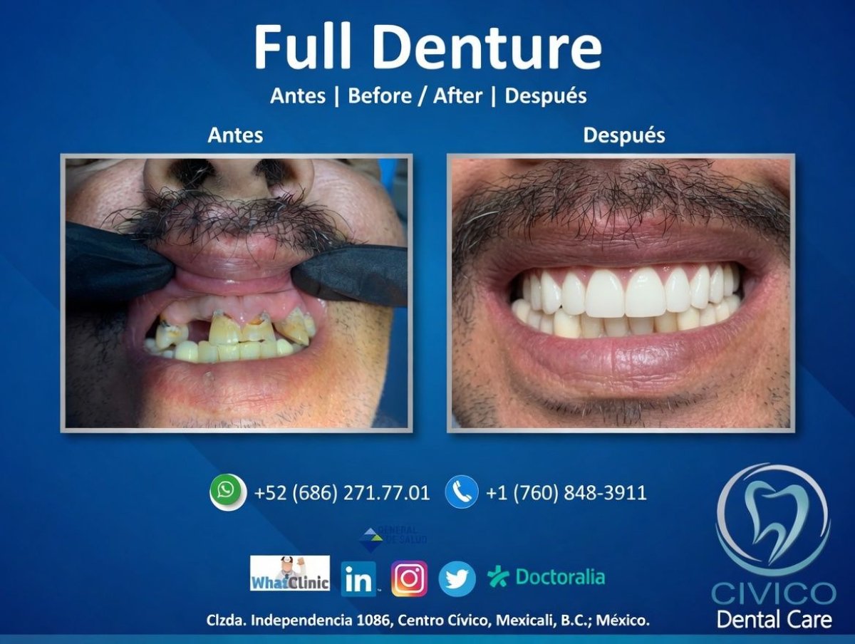 Before and after full denture results at CIVICO DENTAL CARE MEXICALI, smile restoration