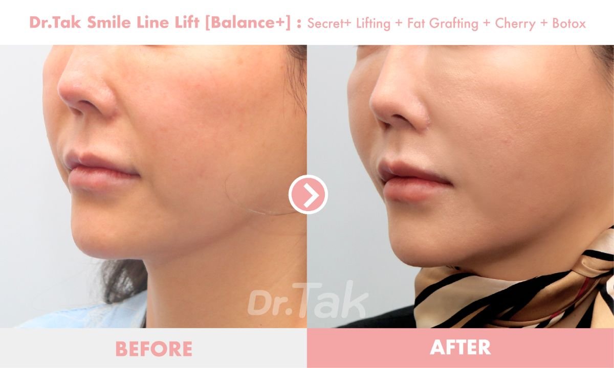 Before and after smile line lift results at Dr. Tak Plastic Surgery, improved nasolabial folds