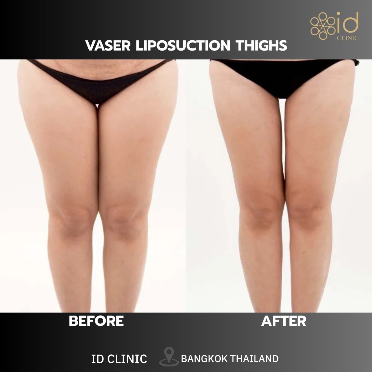 Before and after VASER liposuction thighs result at ID Clinic Bangkok, slimmer thigh contour