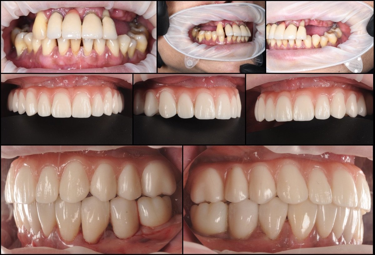 Результаты до и после протезирования в RIKOTA Dental Clinic – полное восстановление улыбки