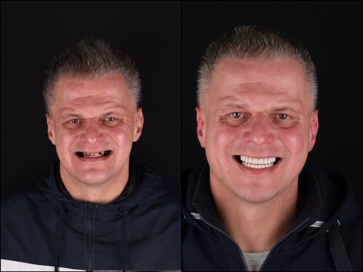 Before and after dental implant results at RIKOTA Dental Clinic – restored full smile