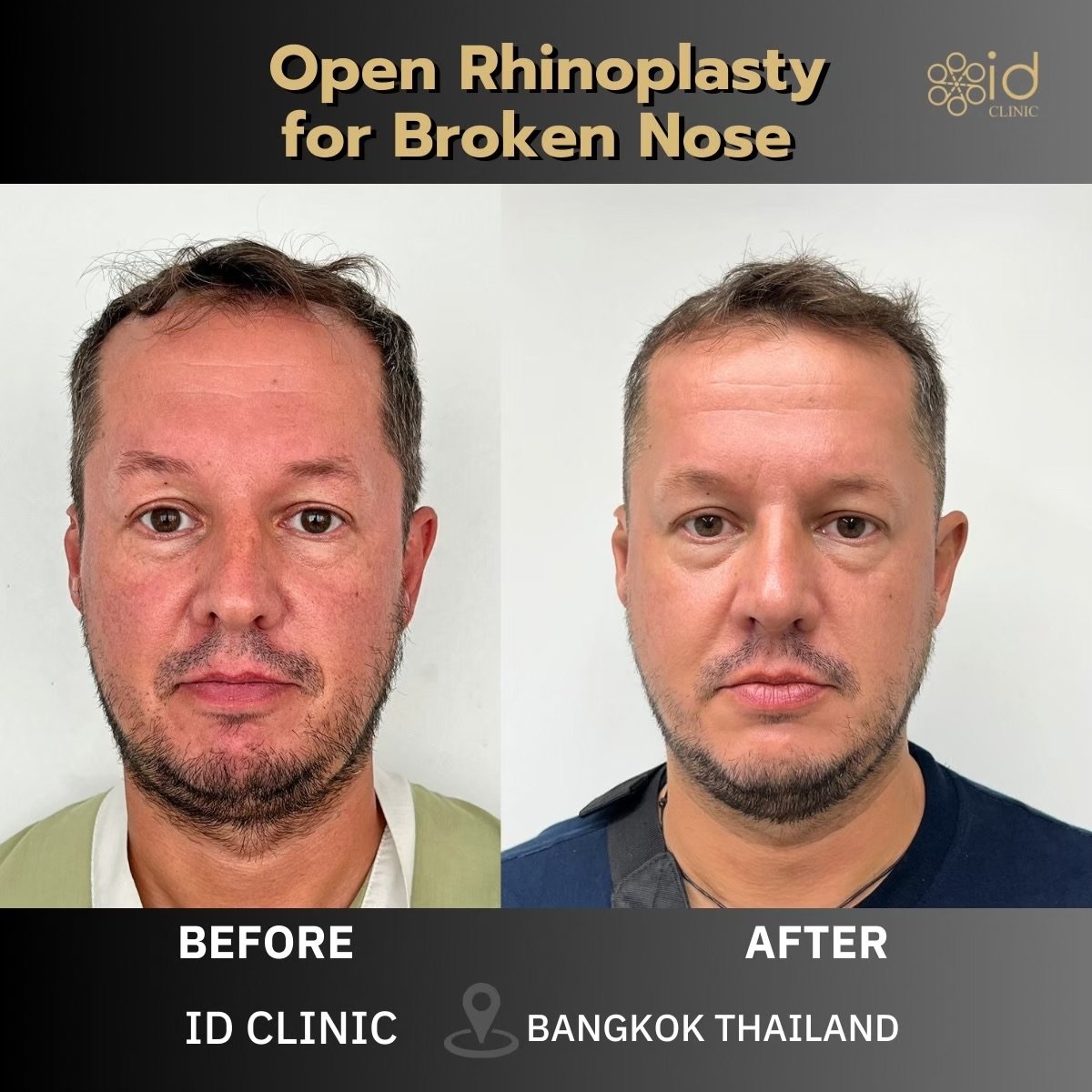 Before and after open rhinoplasty for broken nose at ID Clinic Bangkok, visible nose correction result