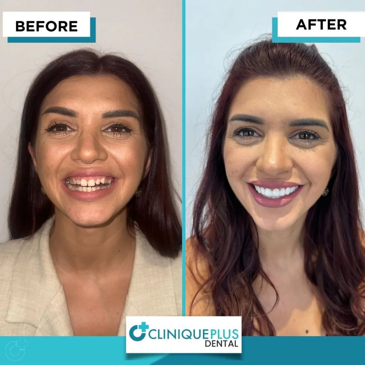 Resultados de blanqueamiento dental antes y después en Clinique Plus Dental – sonrisa más blanca