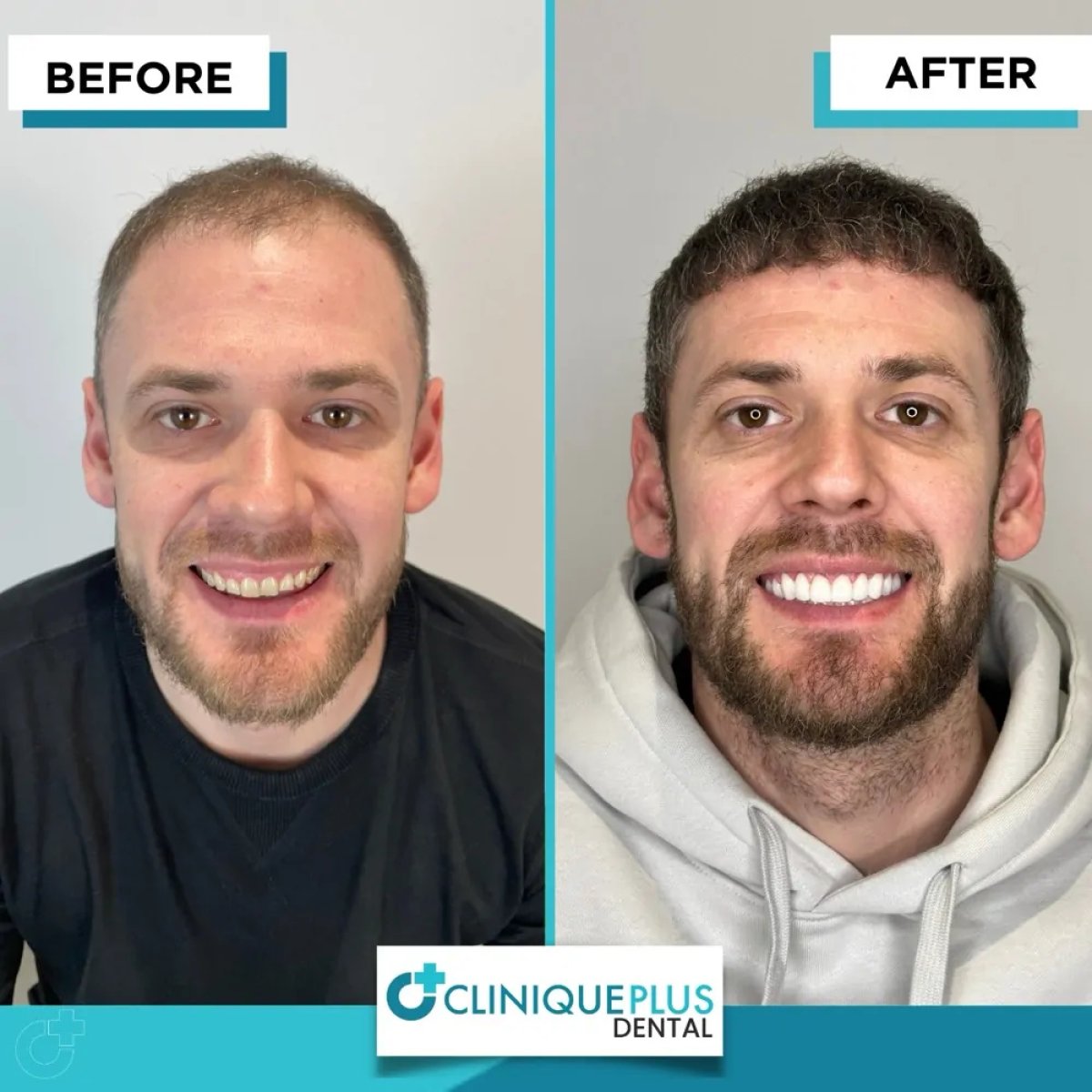 Resultados de blanqueamiento dental antes y después en Clinique Plus Dental – sonrisa más blanca
