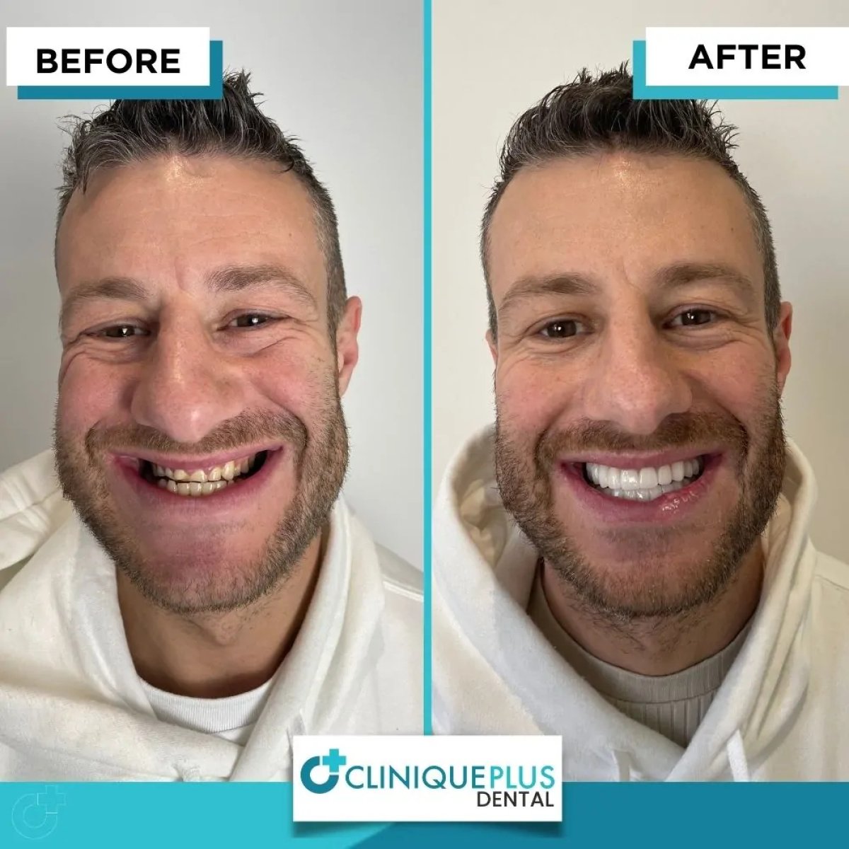 Vorher-nachher Veneers Ergebnis bei Clinique Plus Dental – weißeres Lächeln