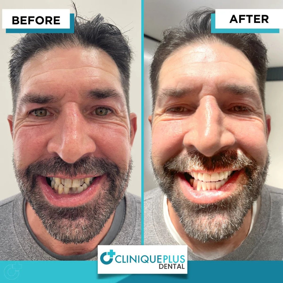 Before and after veneers result at Clinique Plus Dental – smile makeover with natural teeth