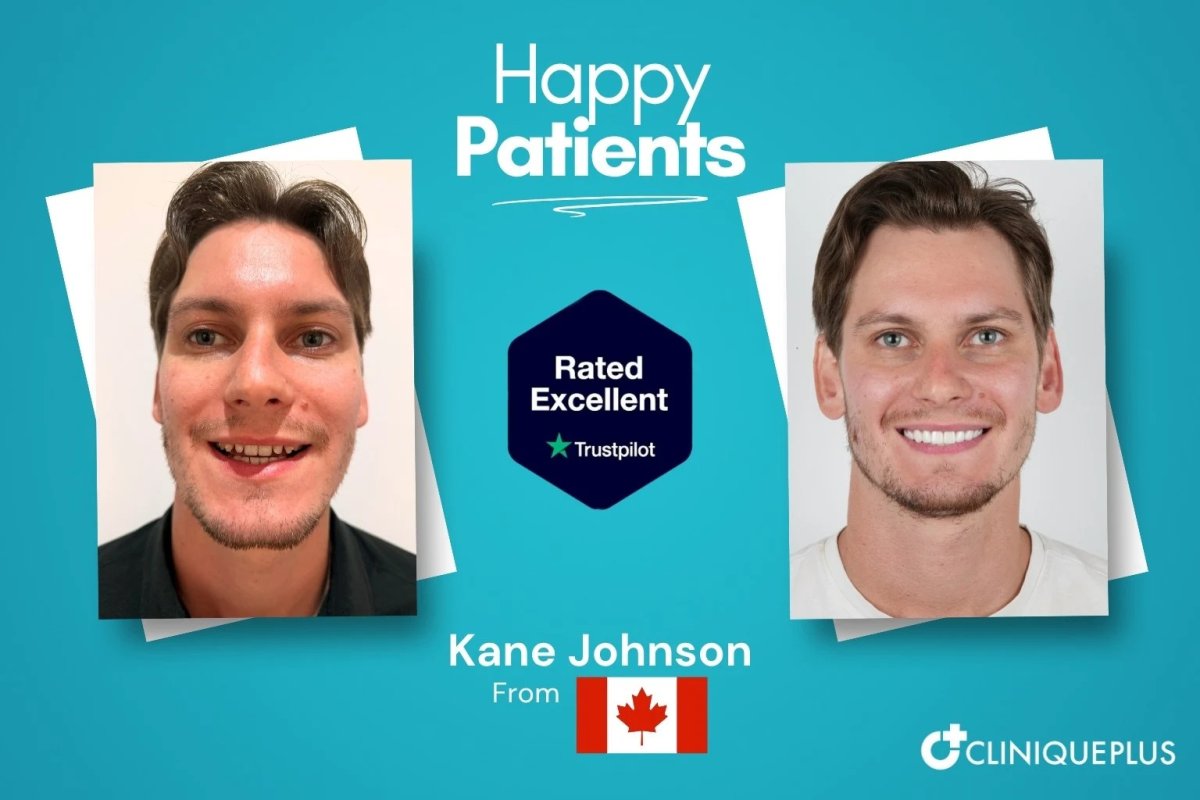 Before and after veneers result at CliniquePlus – smile makeover with natural-looking teeth