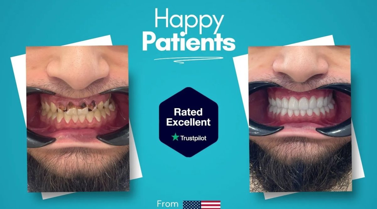 Before and after result of full-arch implant-fixed zirconia dentures, smile restoration