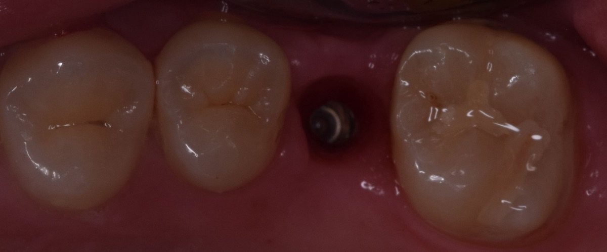 Dental implant placement result at Shanghai Y+bo Dental Clinic, visible implant between teeth