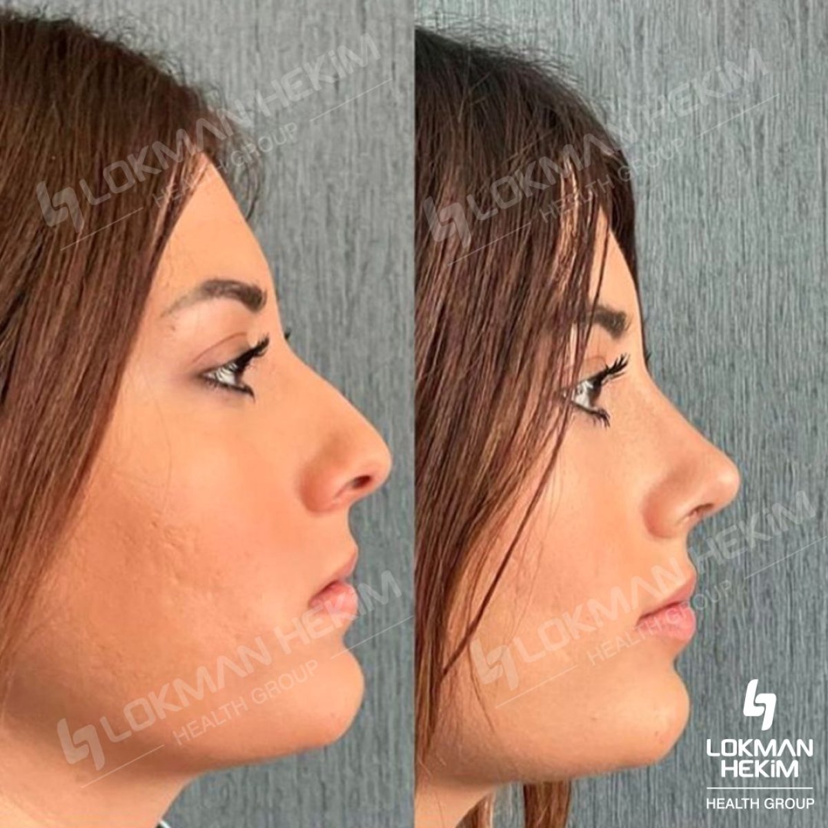 نتائج قبل وبعد تجميل طرف الأنف في مستشفى لوكمان حكيم إسطنبول، إعادة تشكيل الأنف