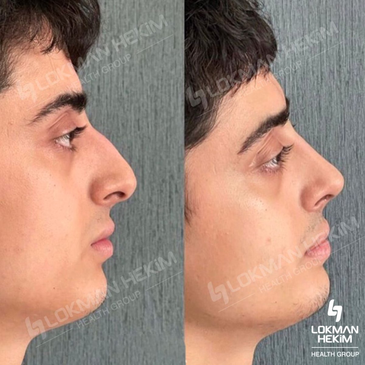 Before and after tip rhinoplasty results at Lokman Hekim Istanbul Hospital, nose reshaping