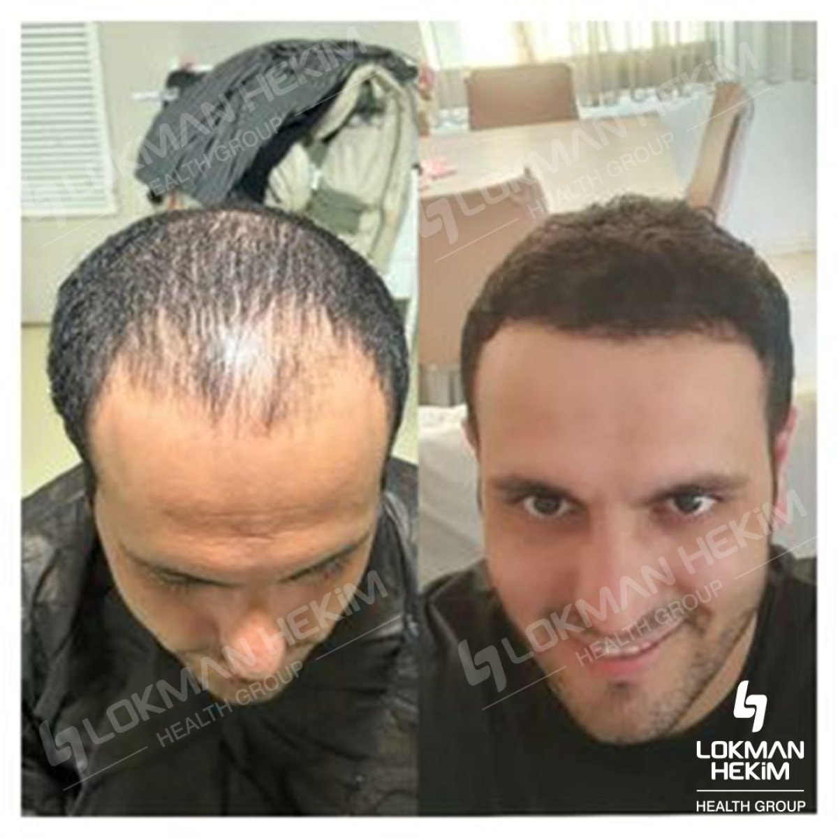 Before and after female hair transplant results at Lokman Hekim Istanbul Hospital, fuller hairline