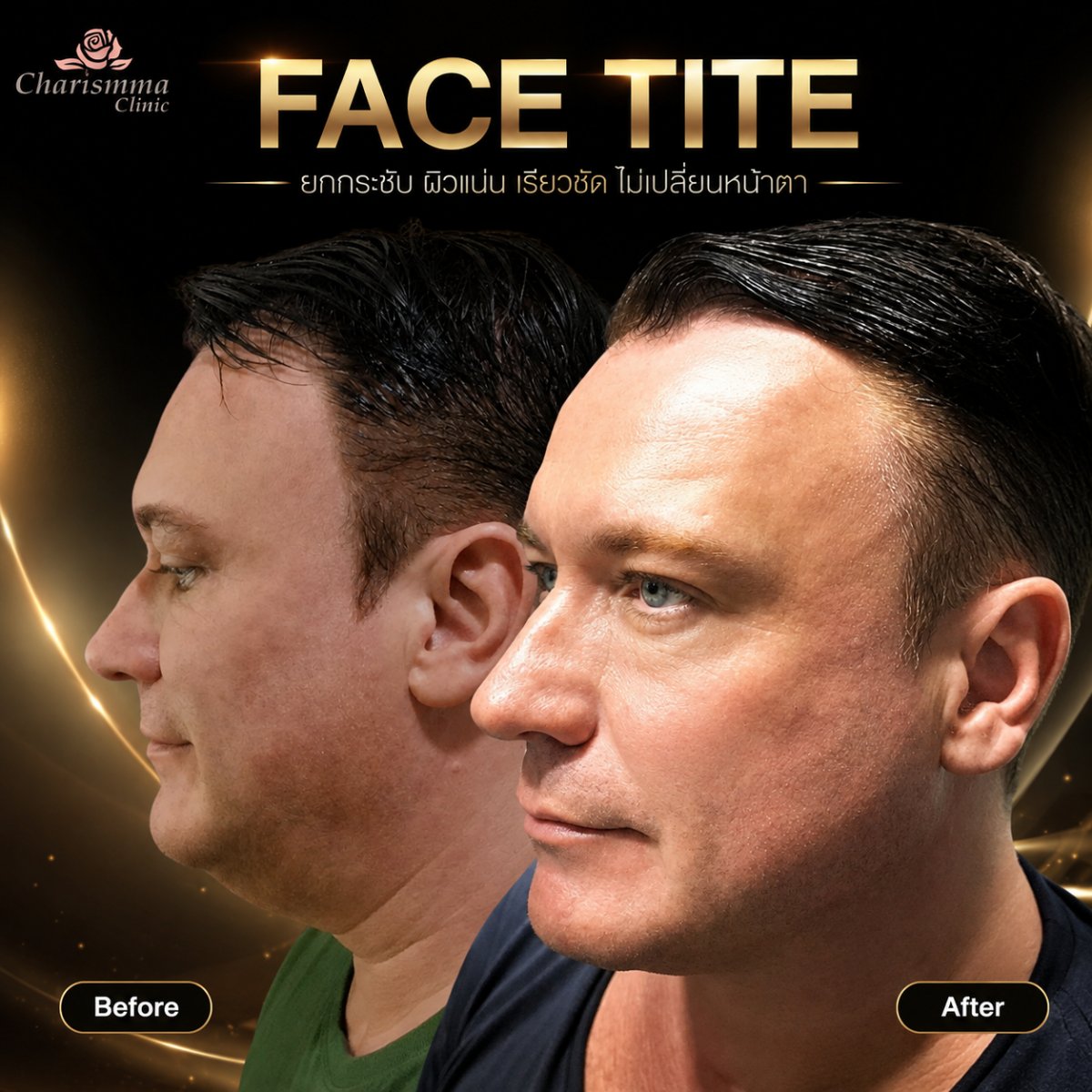 نتائج FaceTite قبل وبعد في Charismma Clinic – تحسين واضح لتحديد الوجه