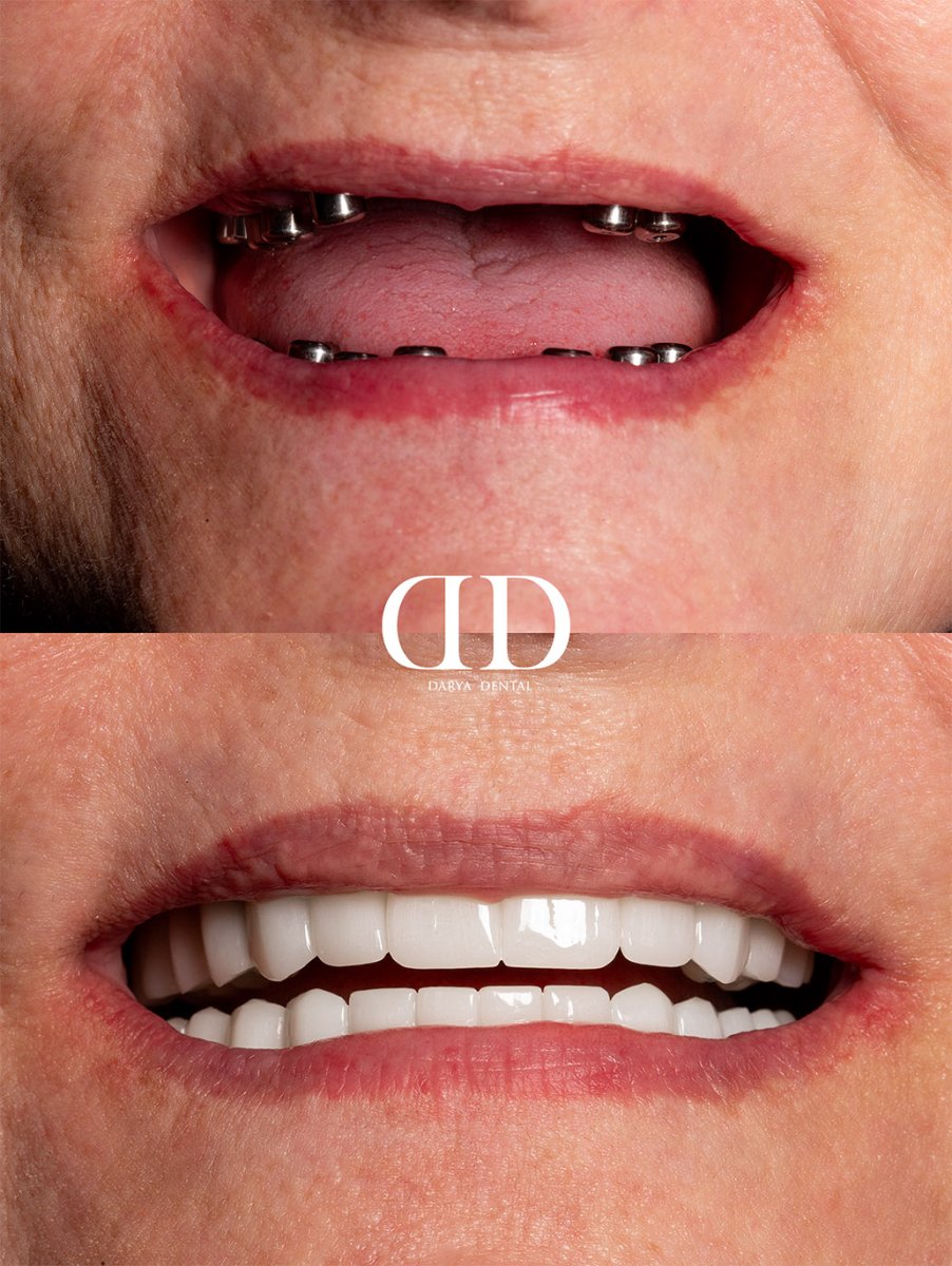 Efekt przed i po implantach All-on-6 w Darya Dental Turkey, pełna odbudowa uśmiechu