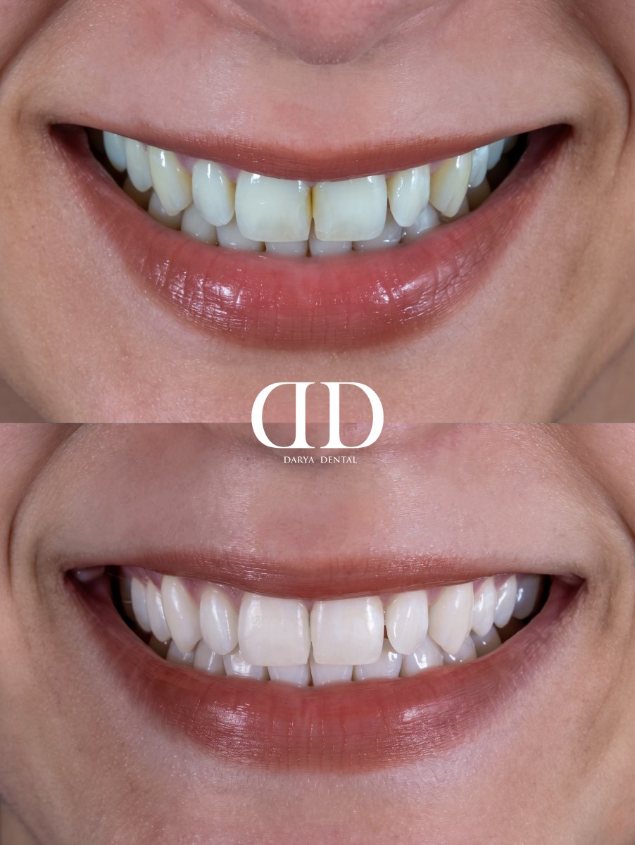 Efekty wybielania zębów przed i po w Darya Dental Turkey, wyraźnie bielszy uśmiech