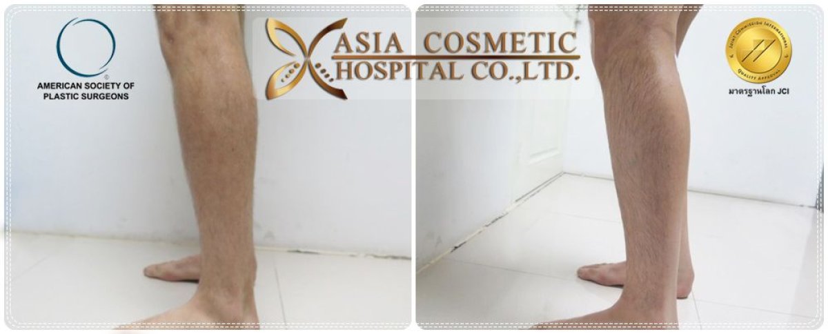 Before and after calf implants at Asia Cosmetic Hospital, visible leg contour enhancement result