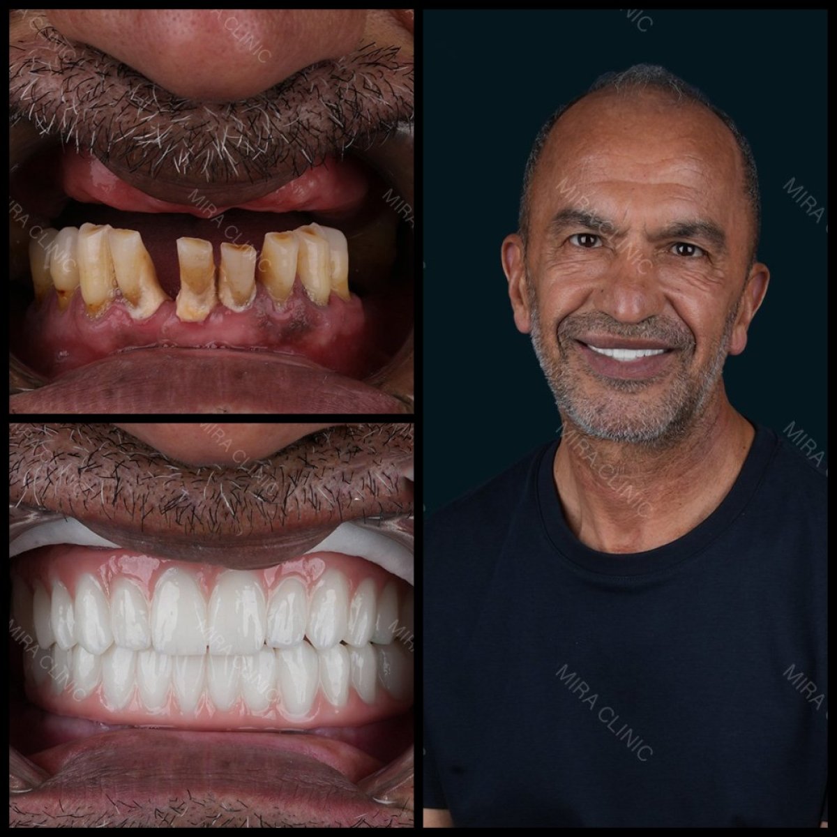 نتائج قبل وبعد تركيب أطقم الأسنان الكاملة في Mira Clinic، ابتسامة ووظيفة مستعادة