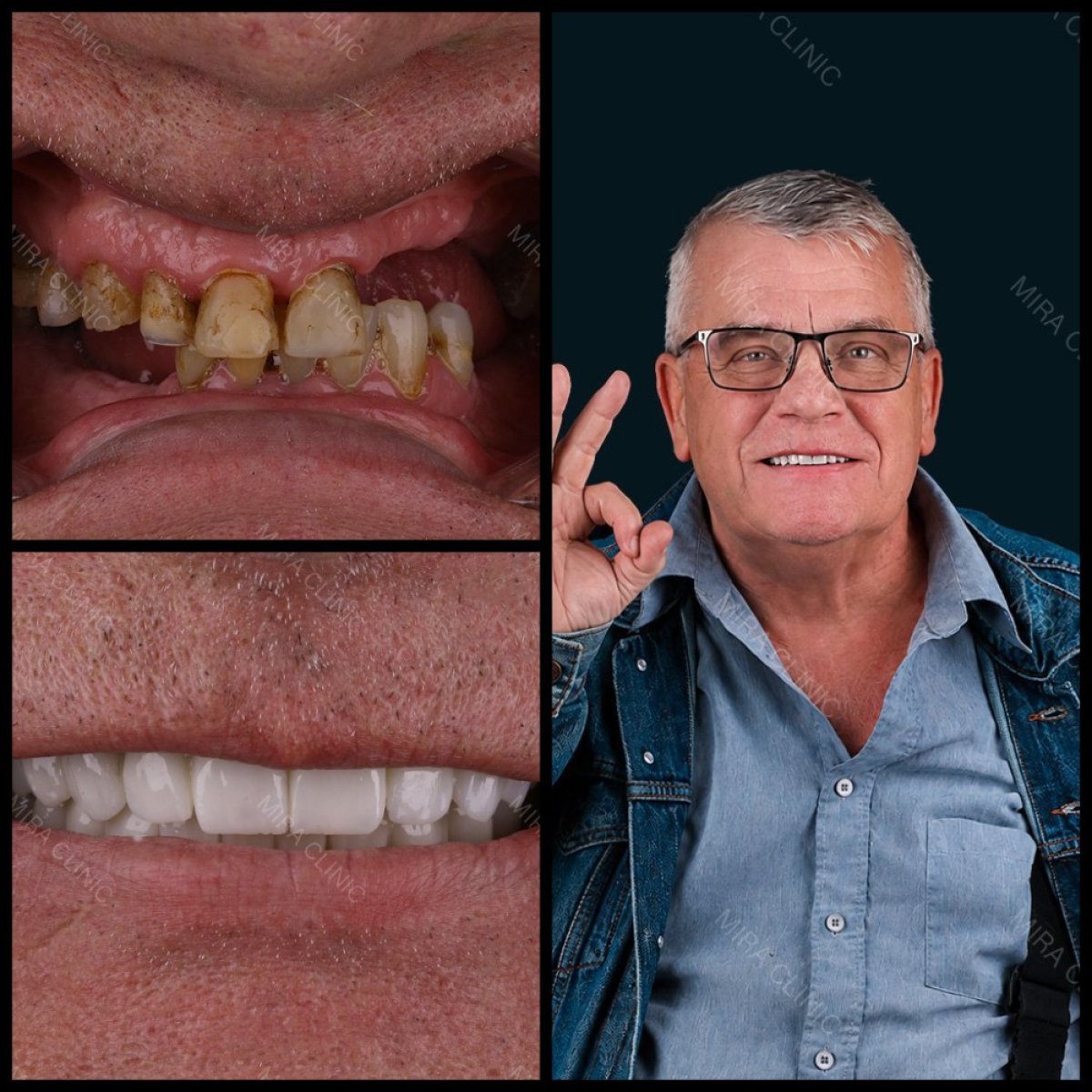 Before and after dental bridge installation at Mira Clinic, improved smile and teeth restoration result