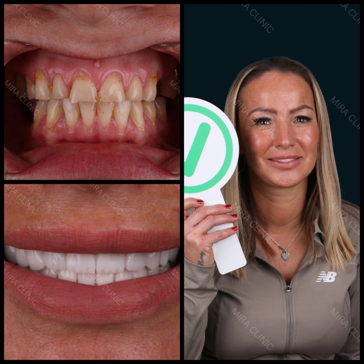 Before and after dental bridge installation results at Mira Clinic, improved smile aesthetics