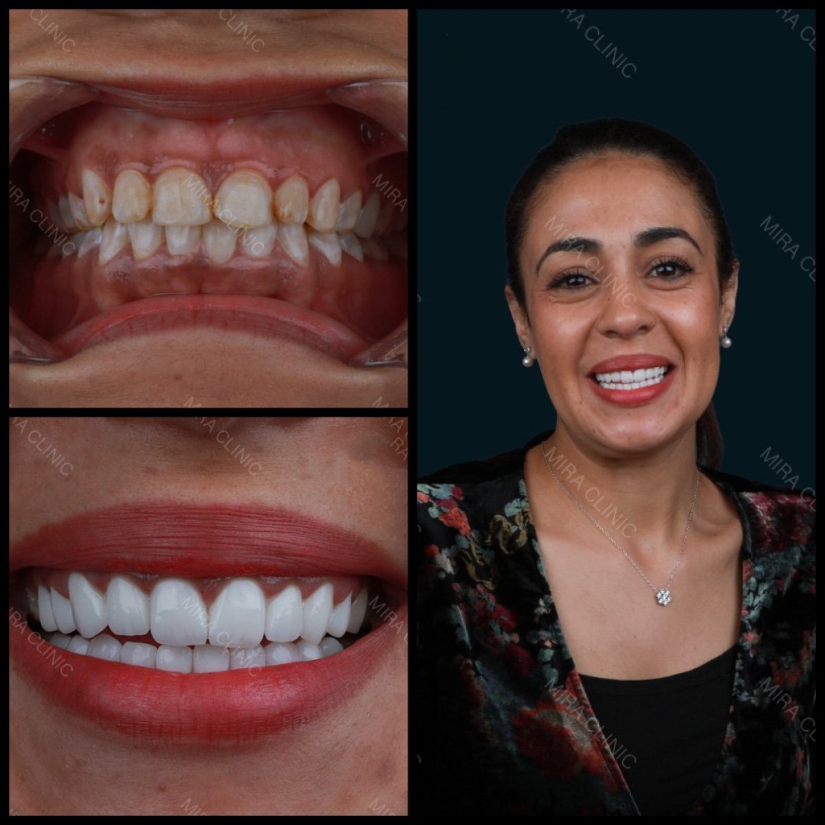 نتائج قبل وبعد تركيب تيجان الزركونيا في Mira Clinic، تحول الابتسامة بشكل طبيعي