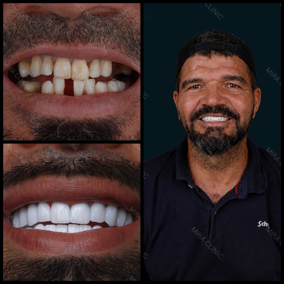 Resultados antes y después de coronas de zirconia en Mira Clinic, transformación de sonrisa