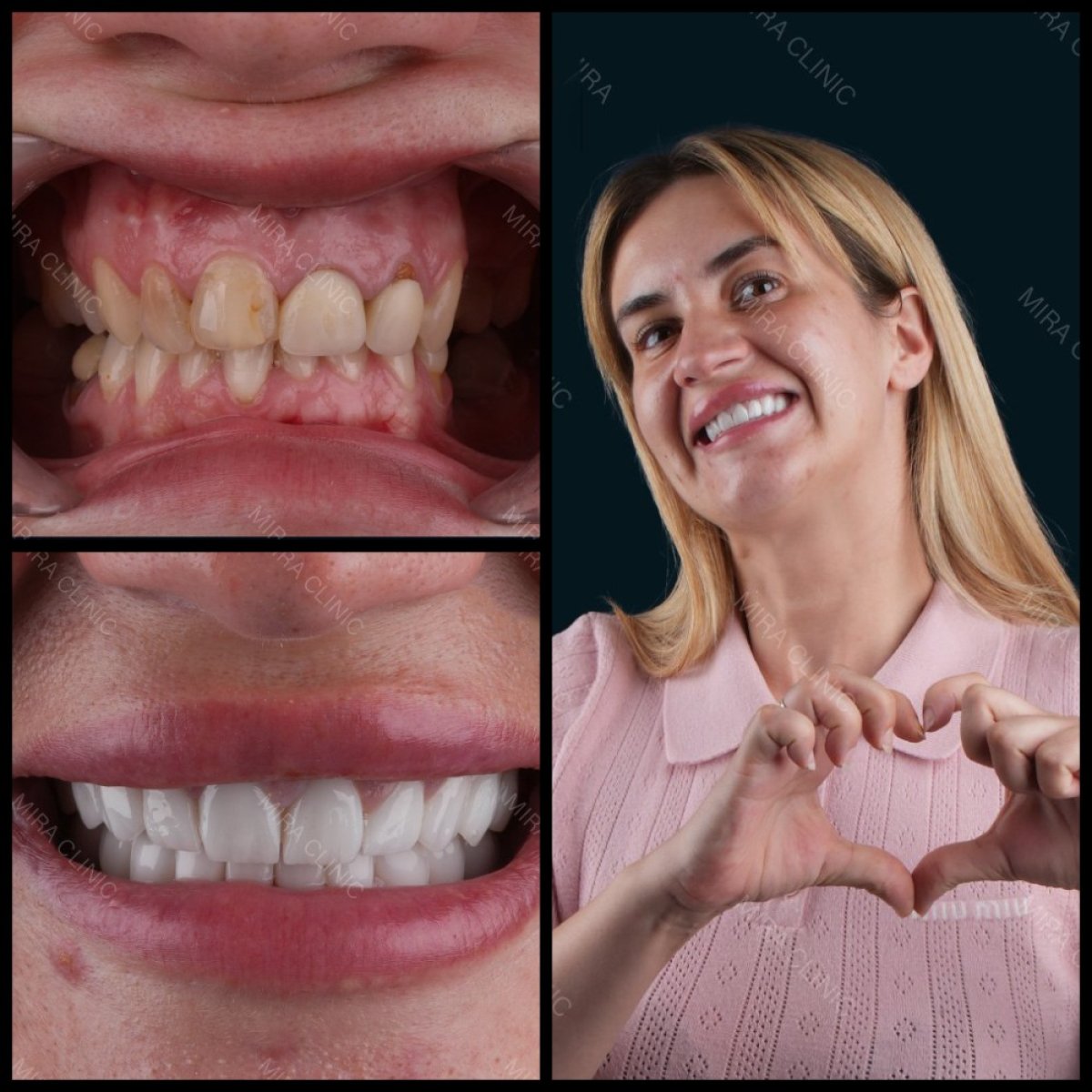Resultados antes y después de coronas de zirconia en Mira Clinic, transformación de sonrisa