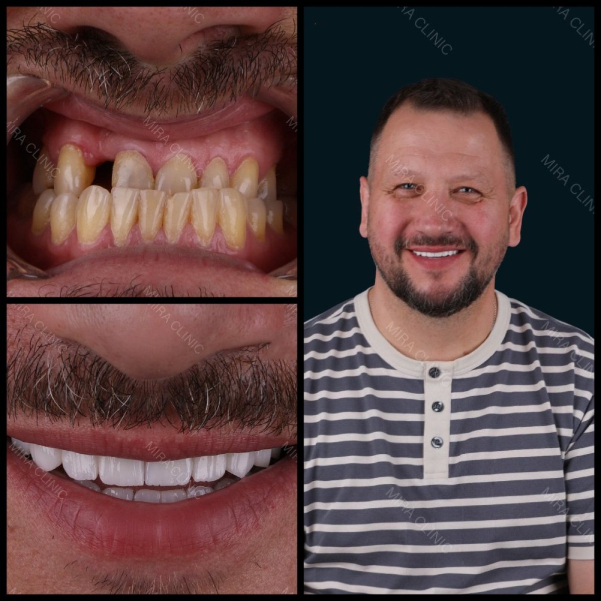 نتائج قبل وبعد تركيب تيجان الأسنان في Mira Clinic، تحول ملحوظ في الابتسامة