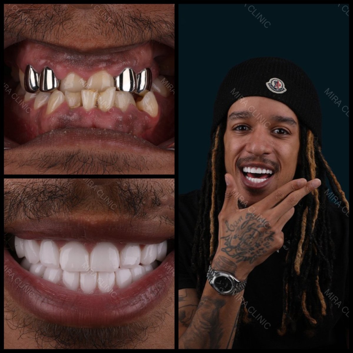 Before and after dental crown installation results at Mira Clinic, smile transformation