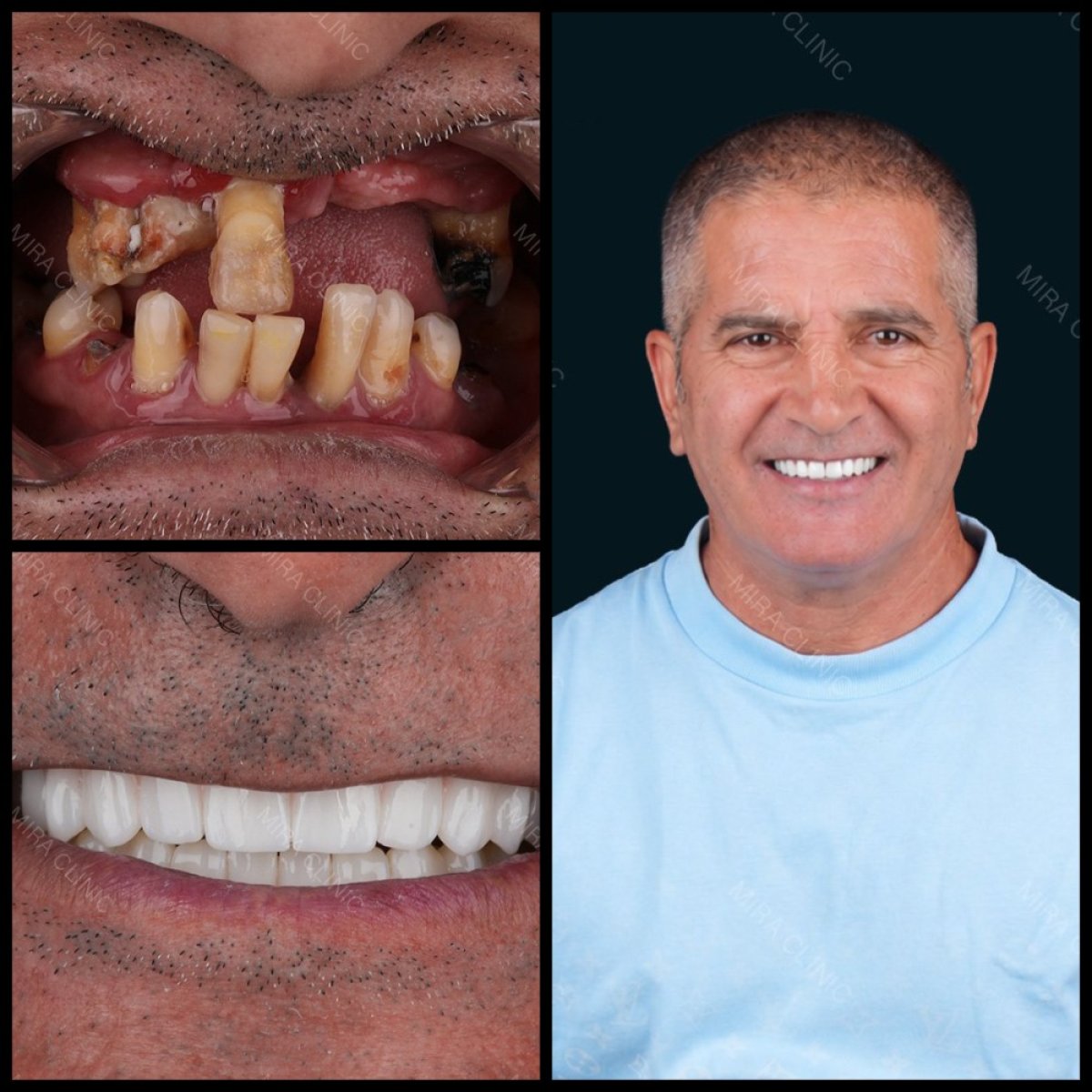 Before and after dental crown installation results at Mira Clinic, restored smile transformation