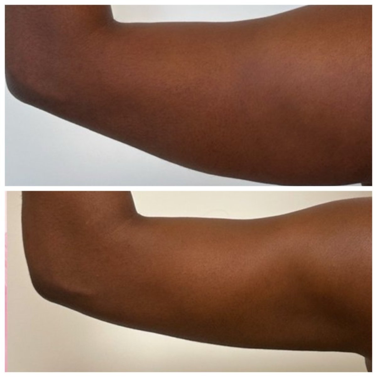 Vorher-nachher-Ergebnis der Armliposuktion in der Somchai Clinic, sichtbare Konturverbesserung
