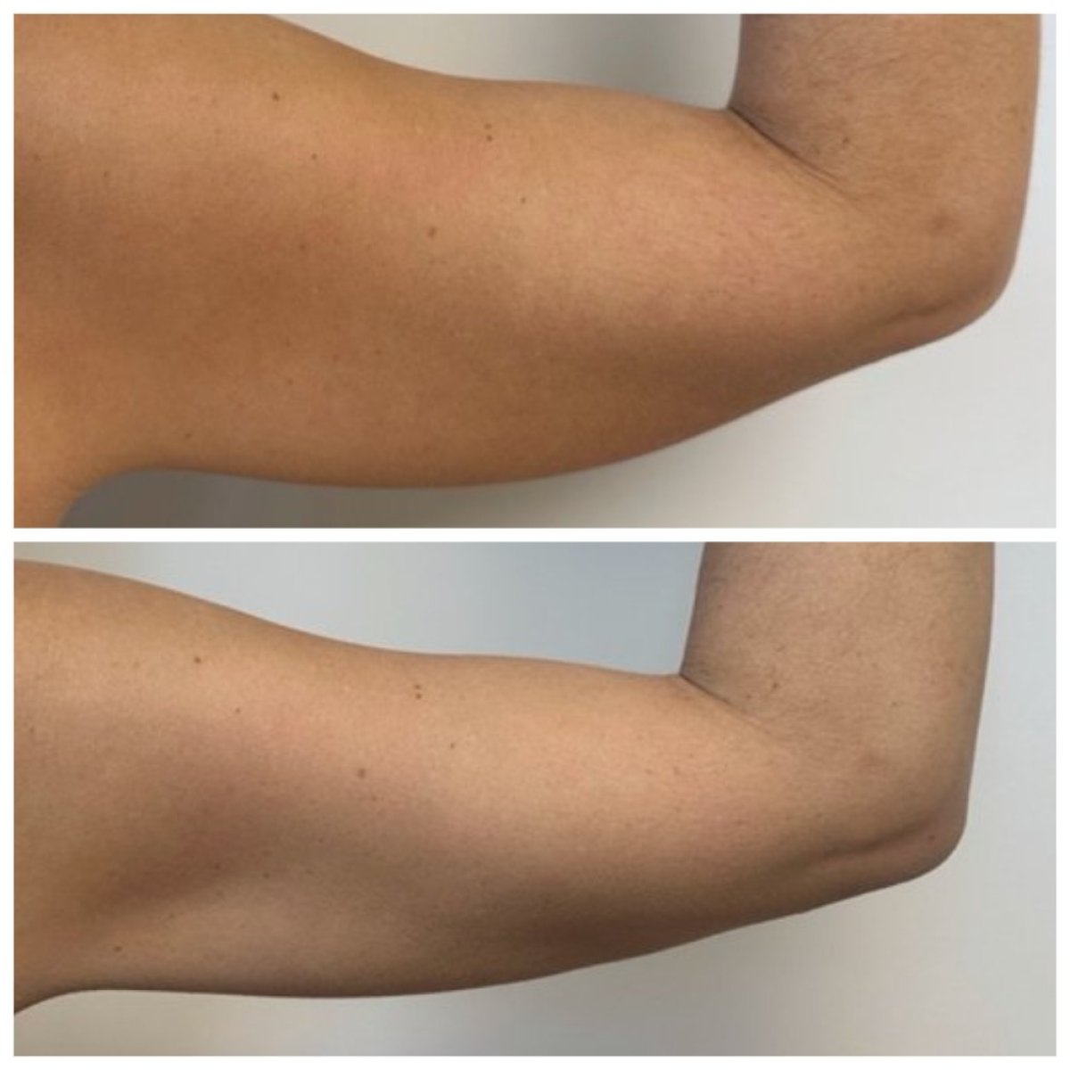 Before and after arm liposuction results at Somchai Clinic, visible fat reduction and contour