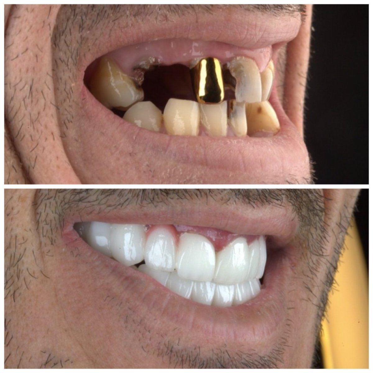 Before and after dental implant results at SUAVE DENTAL CLINIC, restored smile transformation