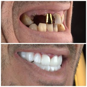 Single Implant with 4* Hotel stay and VIP Transfer - photo 6