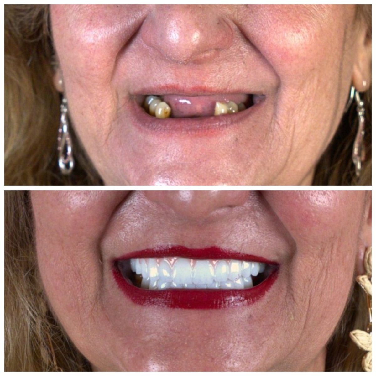 Przed i po założeniu koron zębowych w SUAVE DENTAL CLINIC, efekt odbudowy uśmiechu