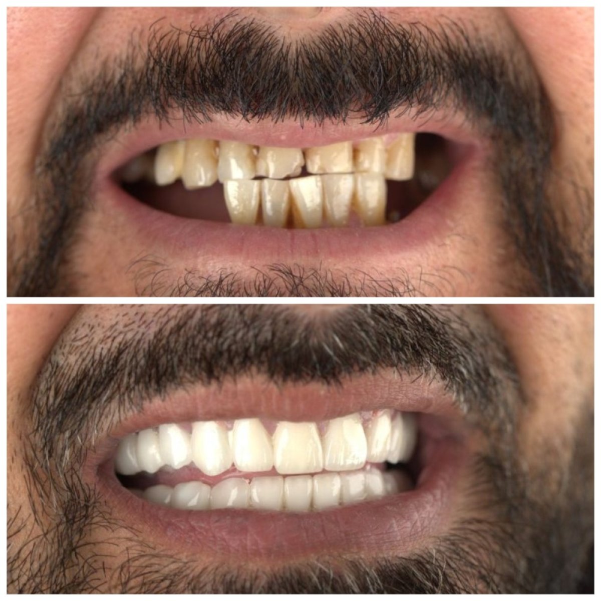 Before and after dental implant results at SUAVE DENTAL CLINIC – restored smile transformation