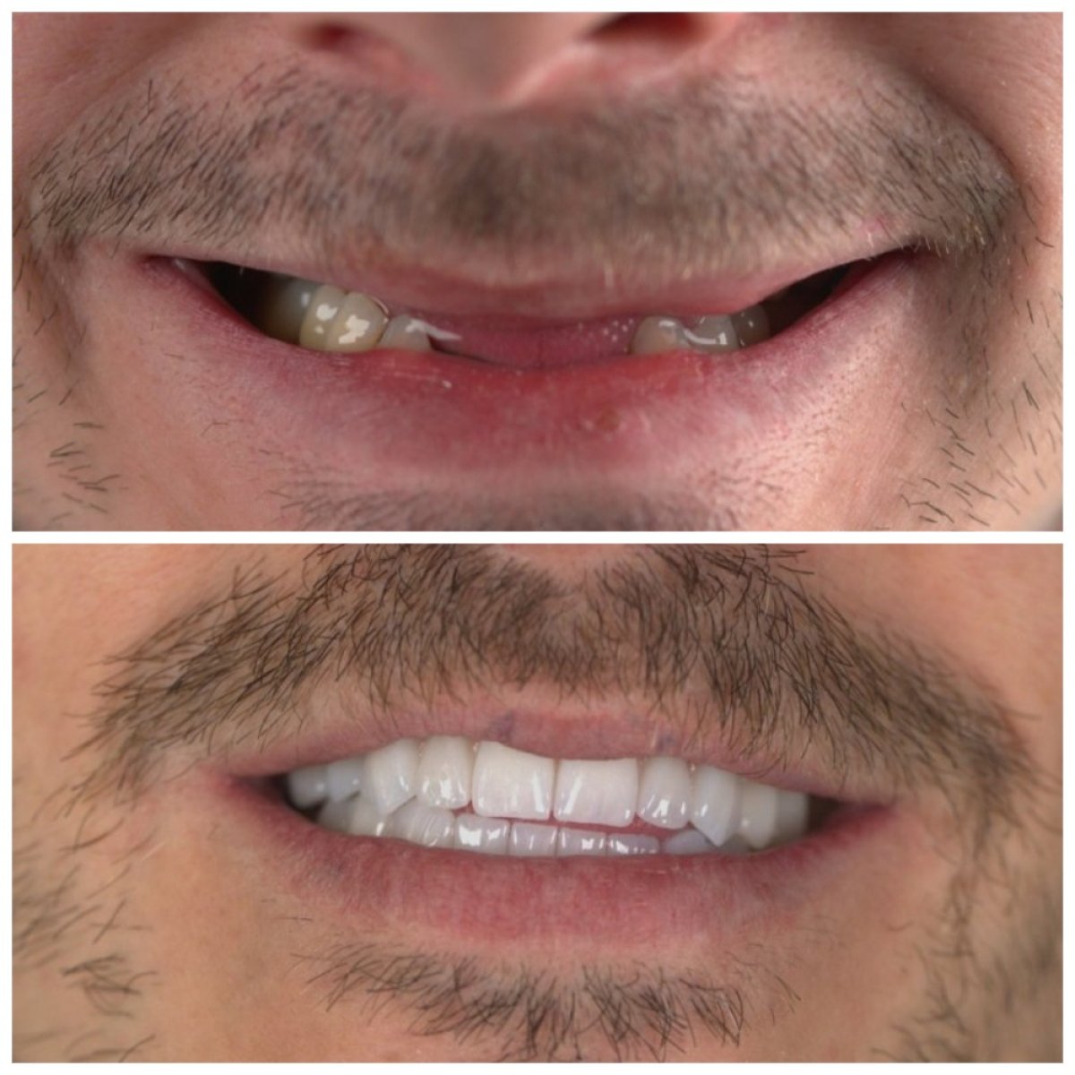 Before and after All-on-6 dental implants result at SUAVE DENTAL CLINIC, restored smile