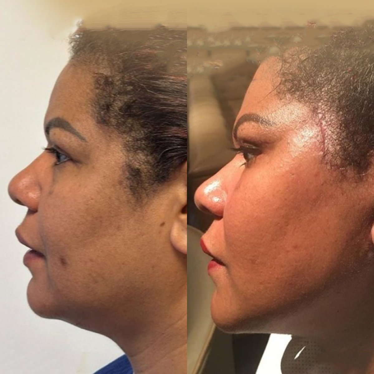Antes y después de extracción de grasa bucal en Dr. Safa Manav Clinic, contorno facial más delgado