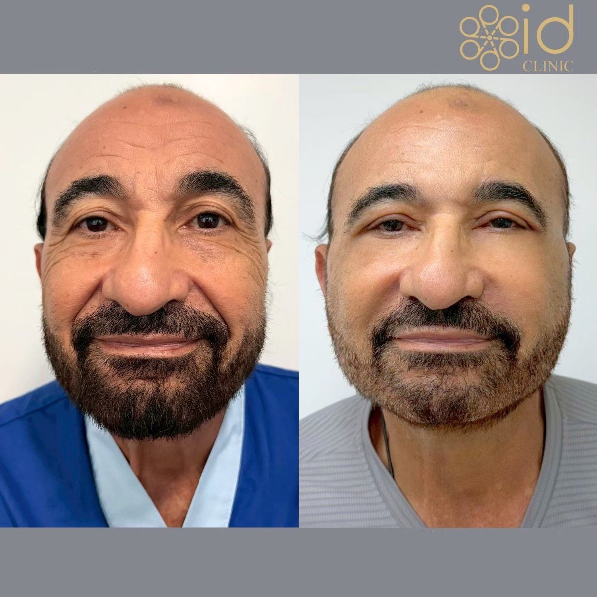 نتائج شد الوجه العميق قبل وبعد في ID Clinic Bangkok، تجديد واضح للوجه