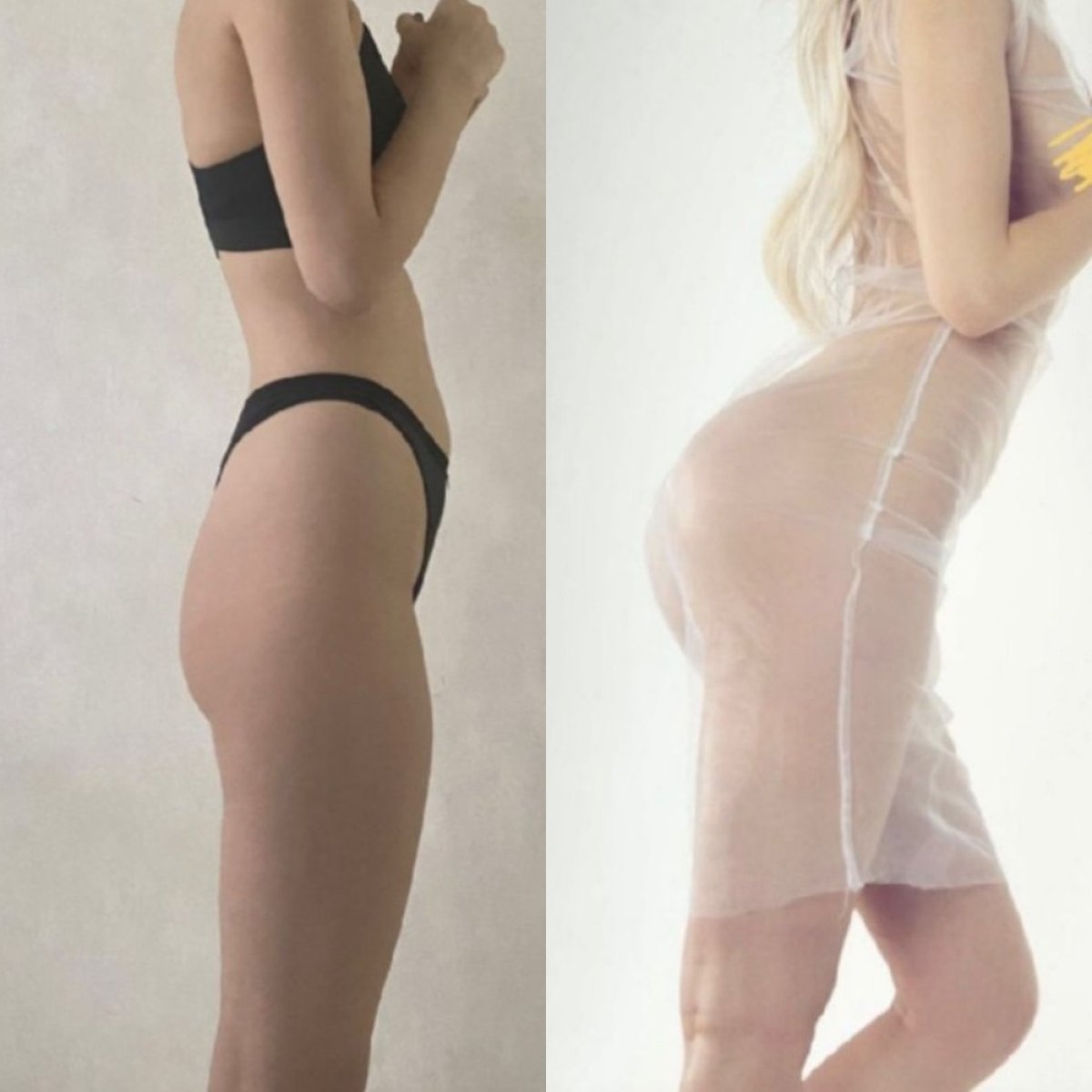 Before and after butt implants at Memorial Şişli Hospital, enhanced curves and volume result