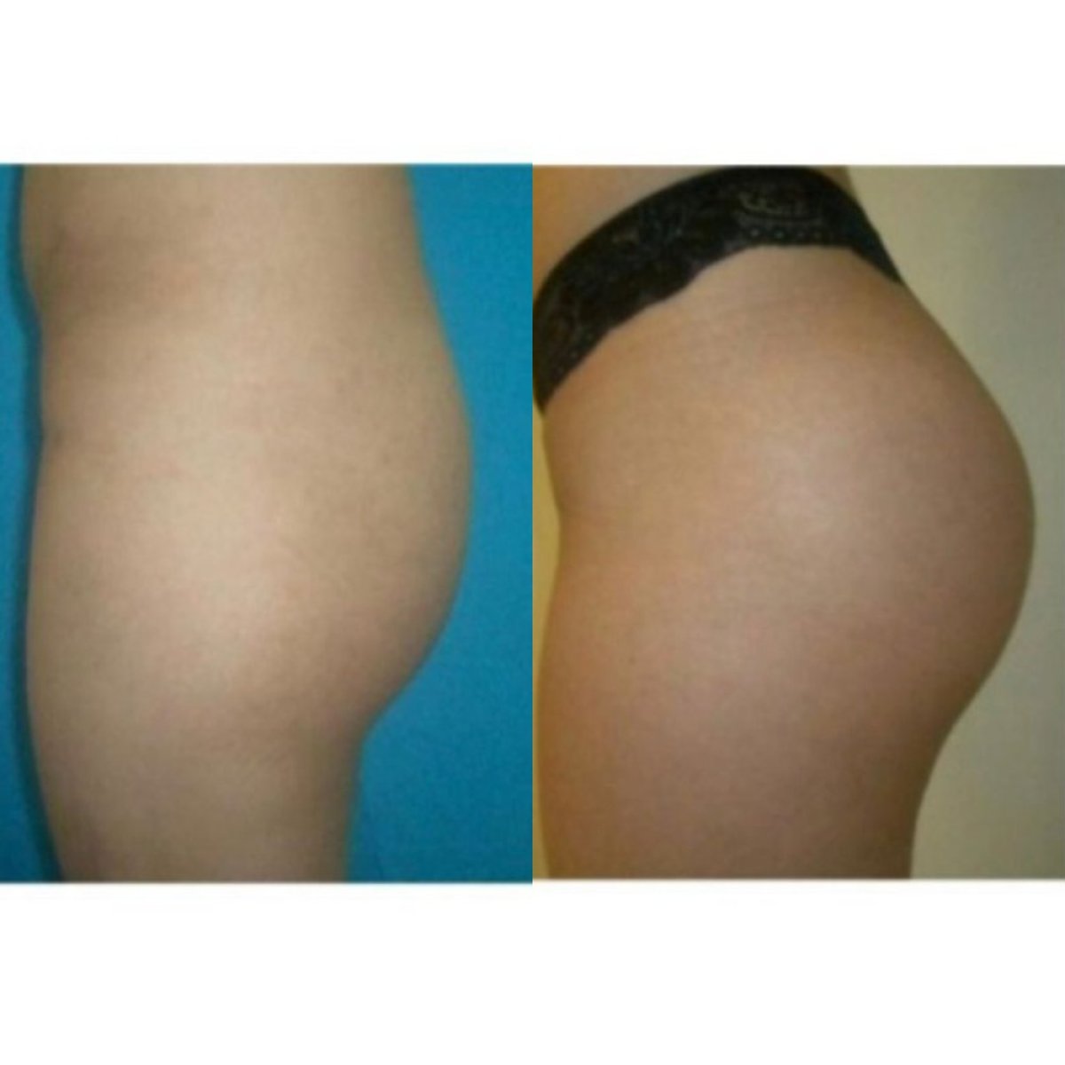 Before and after butt implants at Memorial Şişli Hospital, enhanced gluteal contour result