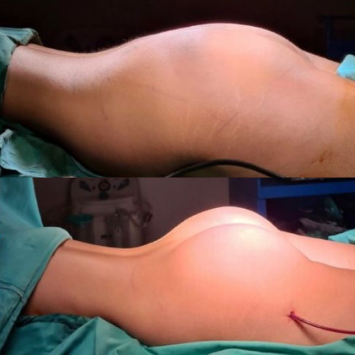 Before and after butt implants at Memorial Şişli Hospital, enhanced gluteal contour result
