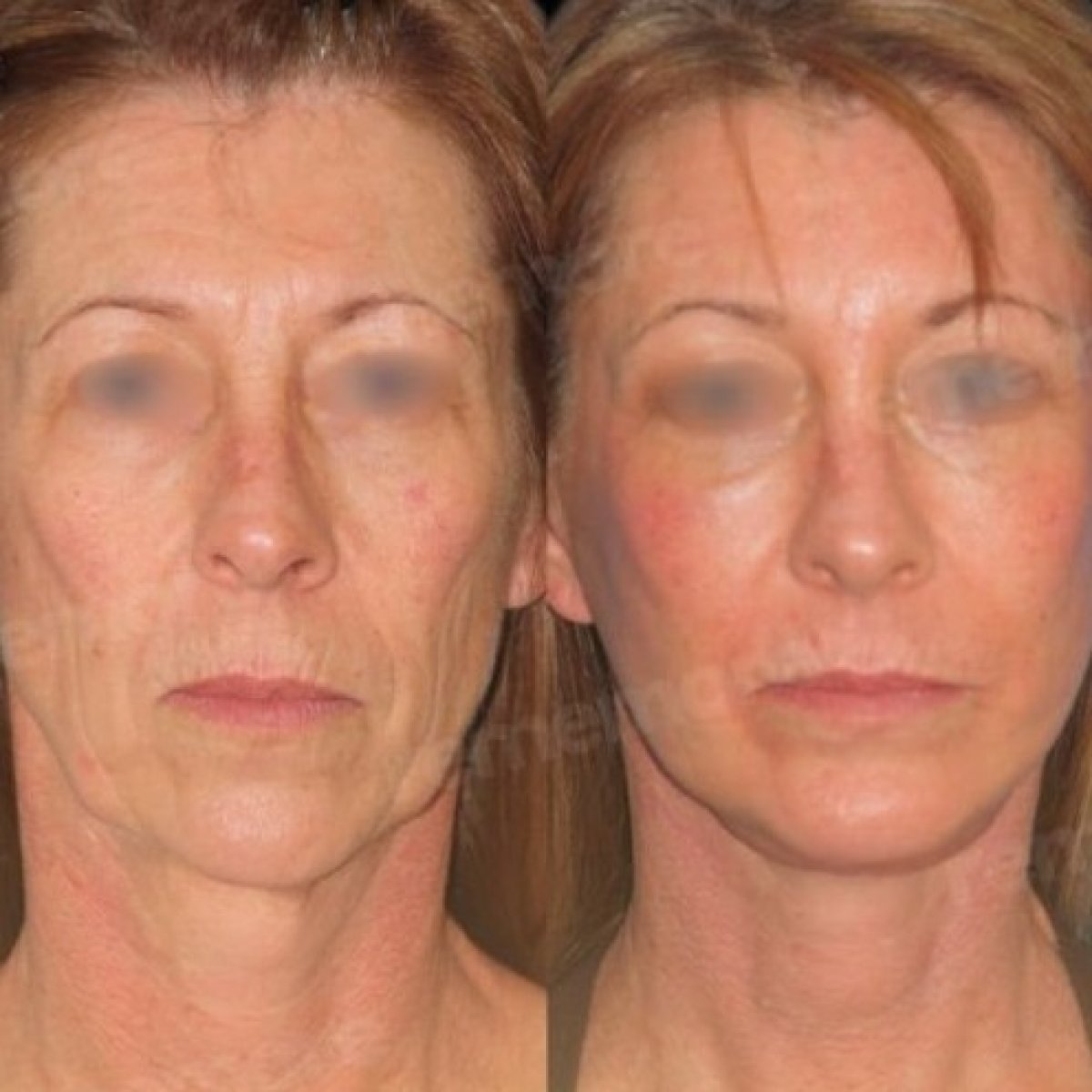 before and after photo