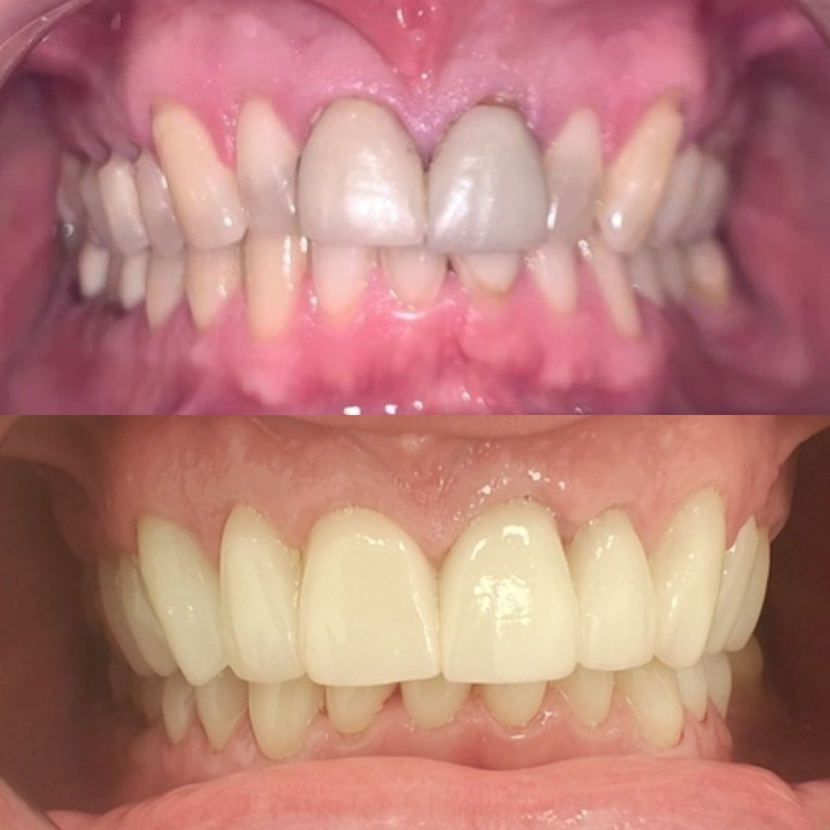 Résultats avant et après couronnes zircone au Dentium Implant Center, restauration du sourire
