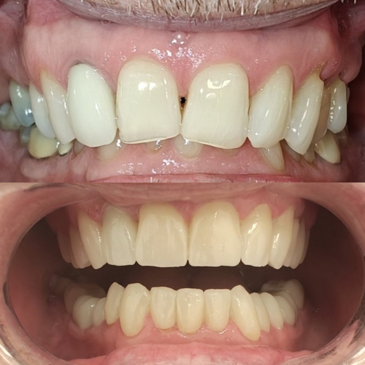 Before and after zirconia crown installation results at Dentium Implant Center, improved smile