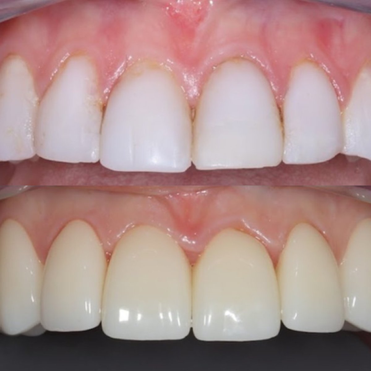 Resultados antes y después de coronas de zirconia en Dentium Implant Center, restauración de sonrisa