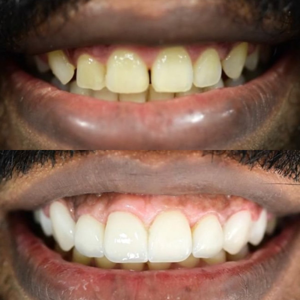 Результаты до и после улыбки в Punta cana dentist odontologia familiar, белые зубы