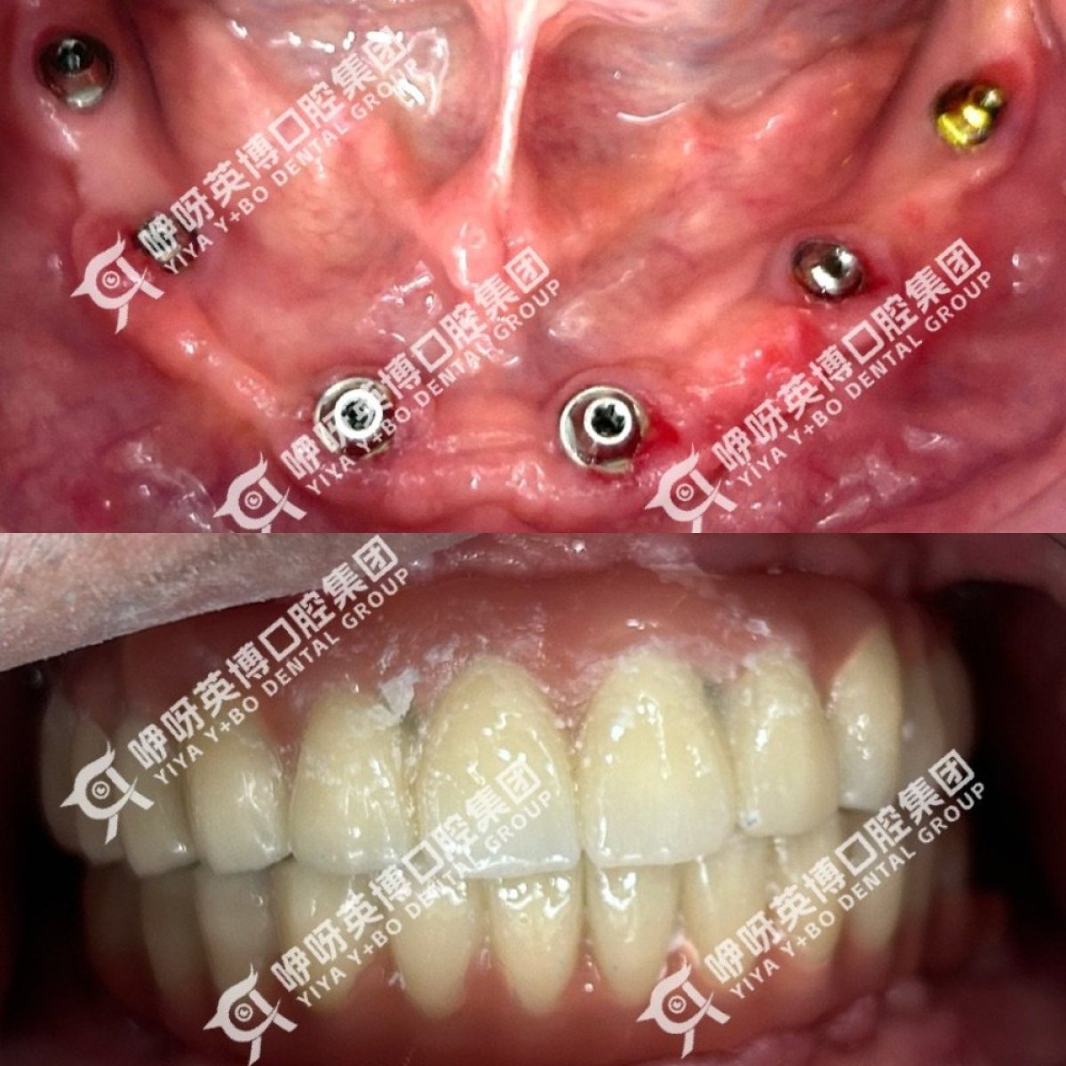 Resultados de implantes dentales All-on-4 inmediatos antes y después en Shanghai Y+bo