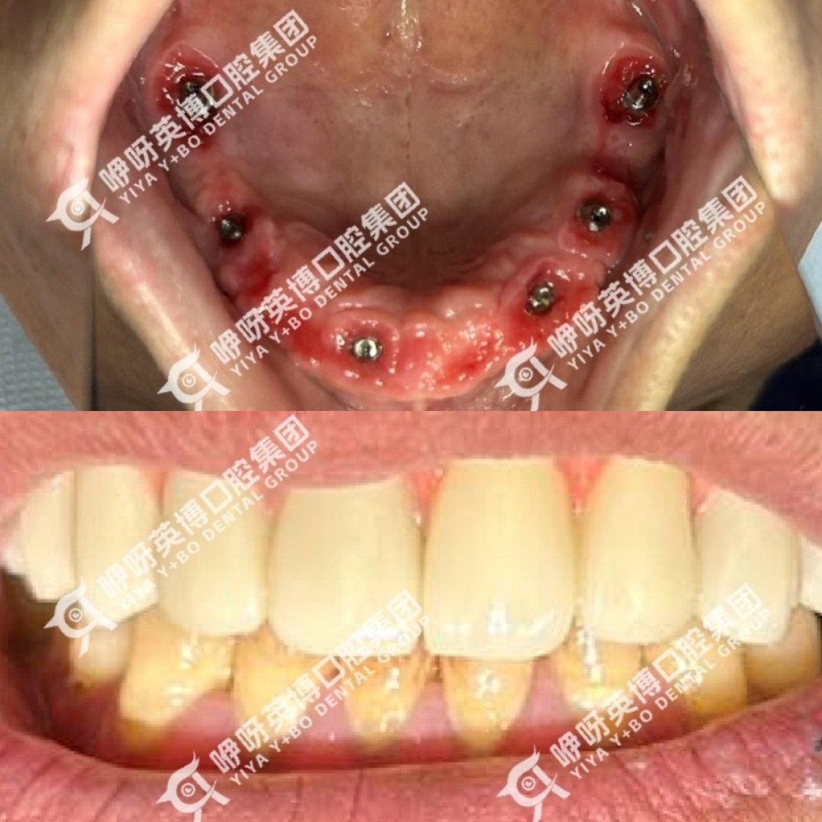 Resultados de implantes dentales All-on-4 inmediatos antes y después en Shanghai Y+bo Dental