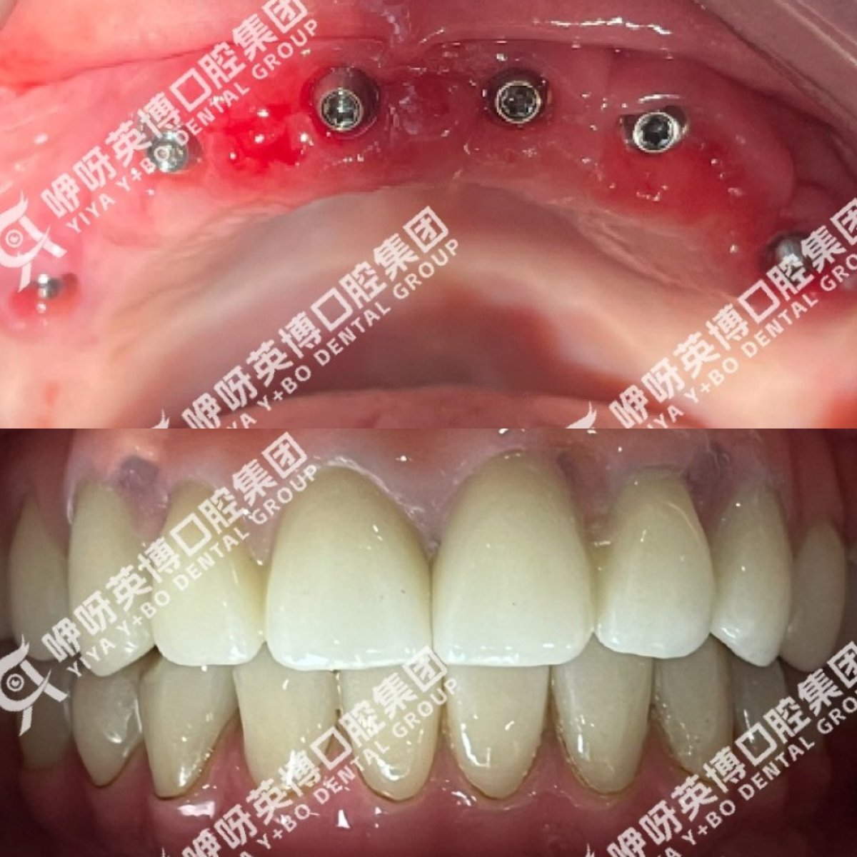 Resultados antes y después de implantes dentales All-on-4 en Shanghai Y+bo Dental Clinic