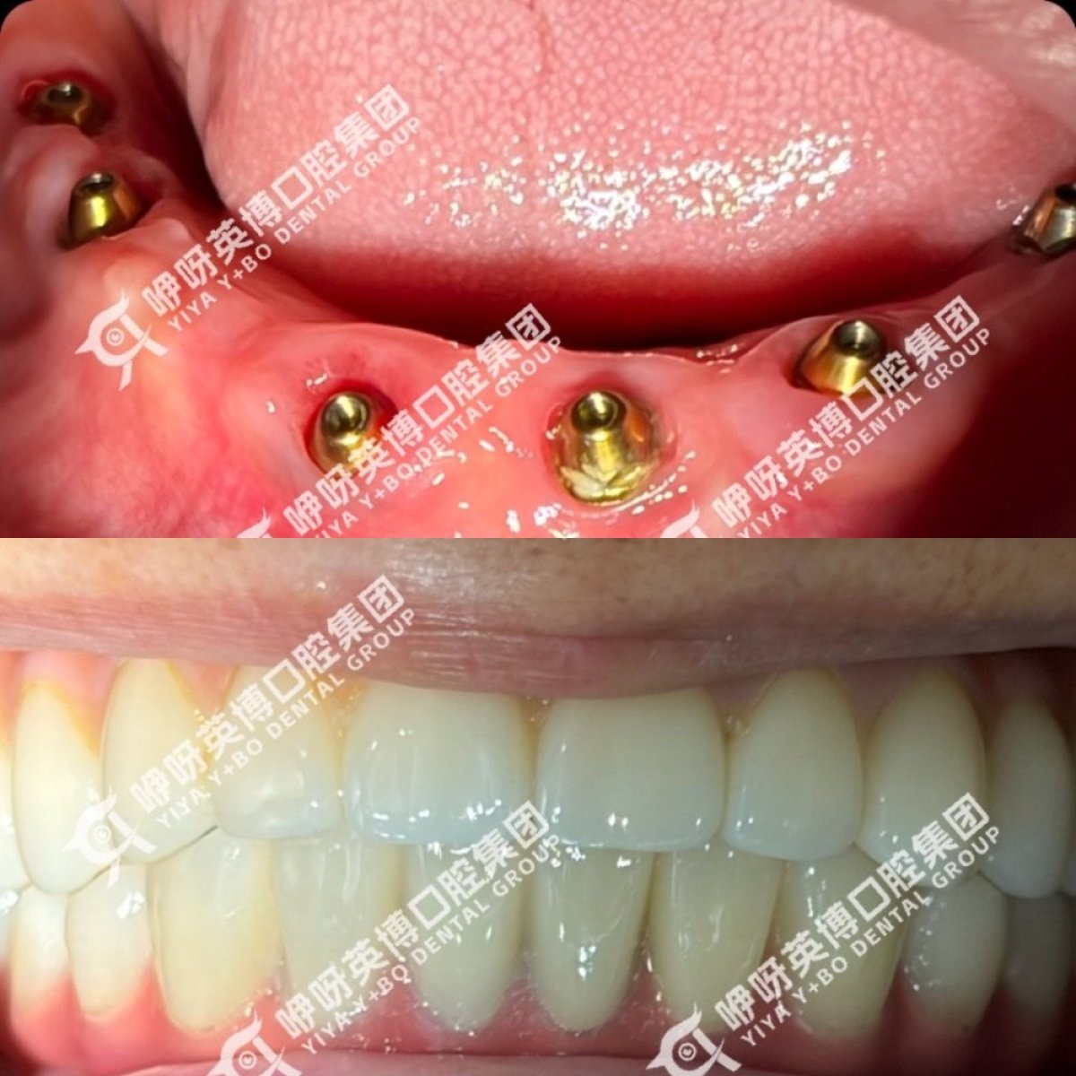 Résultat avant/après implants dentaires All-on-4 immédiats à Shanghai Y+bo Dental Clinic